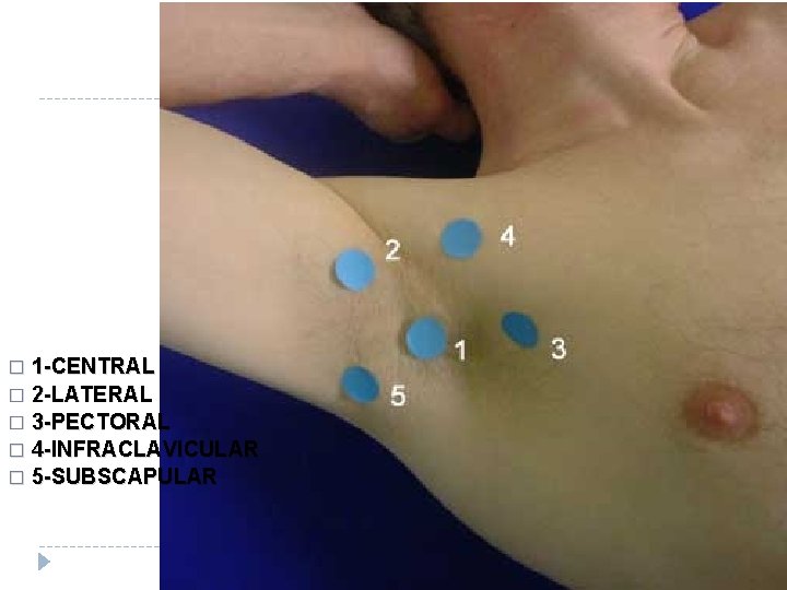 1 -CENTRAL � 2 -LATERAL � 3 -PECTORAL � 4 -INFRACLAVICULAR � 5 -SUBSCAPULAR