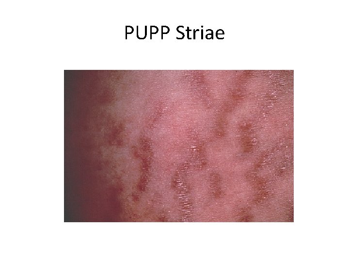 PUPP Striae 