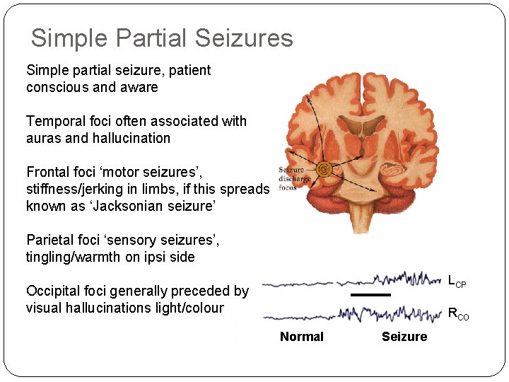 Simple Partial Seizures Simple partial seizure, patient conscious and aware Temporal foci often associated