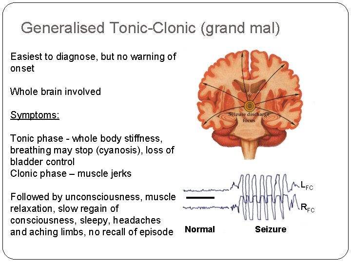 Generalised Tonic-Clonic (grand mal) Easiest to diagnose, but no warning of onset Whole brain