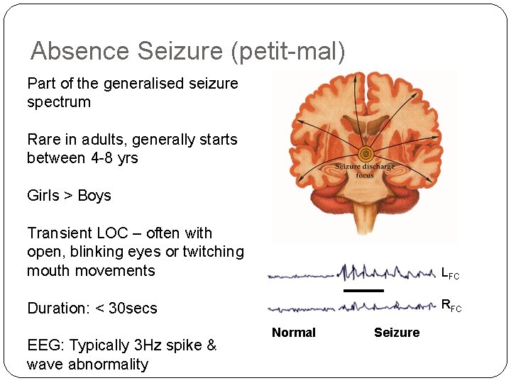 Absence Seizure (petit-mal) Part of the generalised seizure spectrum Rare in adults, generally starts