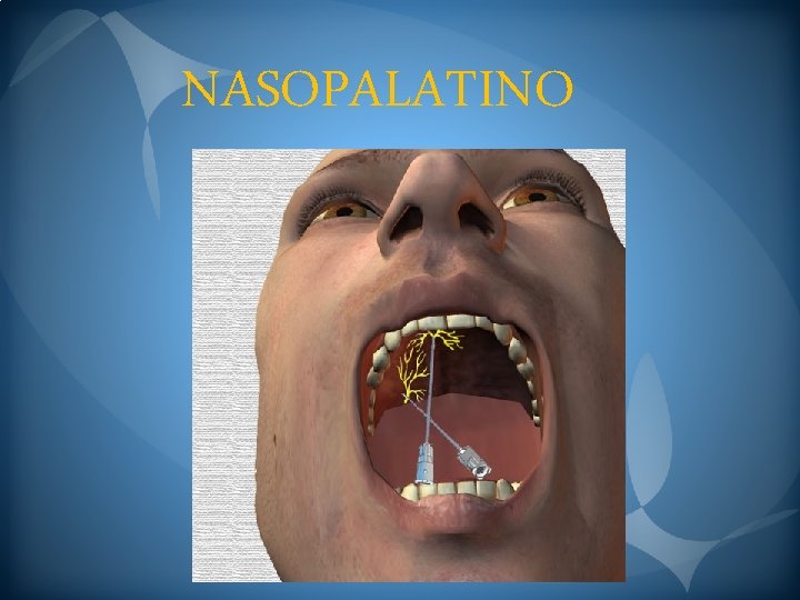 NASOPALATINO 