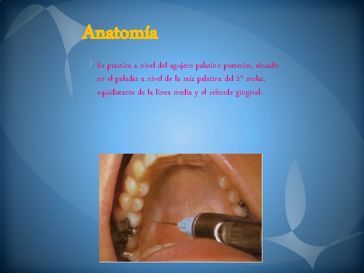 Anatomía Se practica a nivel del agujero palatino posterior, situado en el paladar a