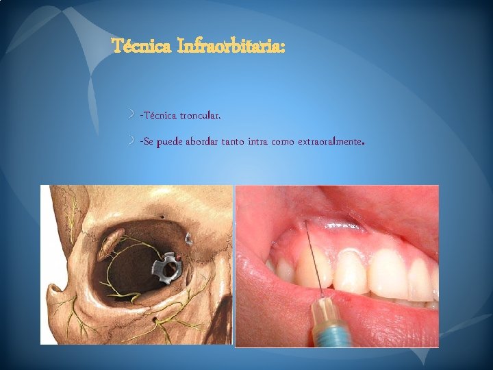 Técnica Infraorbitaria: -Técnica troncular. -Se puede abordar tanto intra como extraoralmente. 