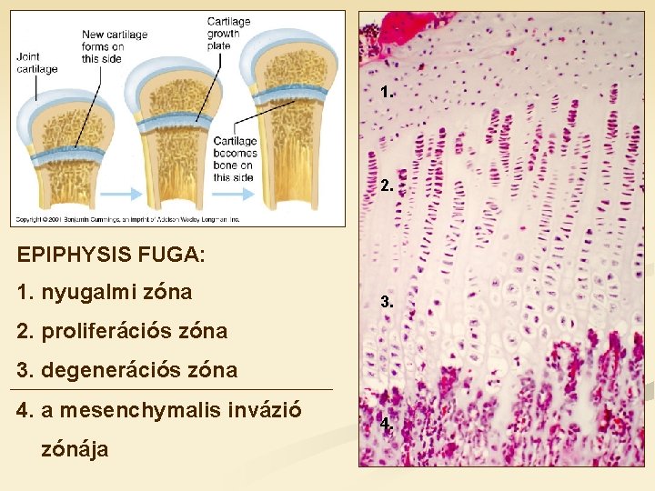 1. 2. EPIPHYSIS FUGA: 1. nyugalmi zóna 3. 2. proliferációs zóna 3. degenerációs zóna