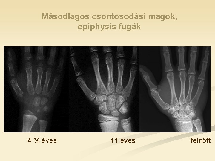 Másodlagos csontosodási magok, epiphysis fugák 4 ½ éves 11 éves felnőtt 