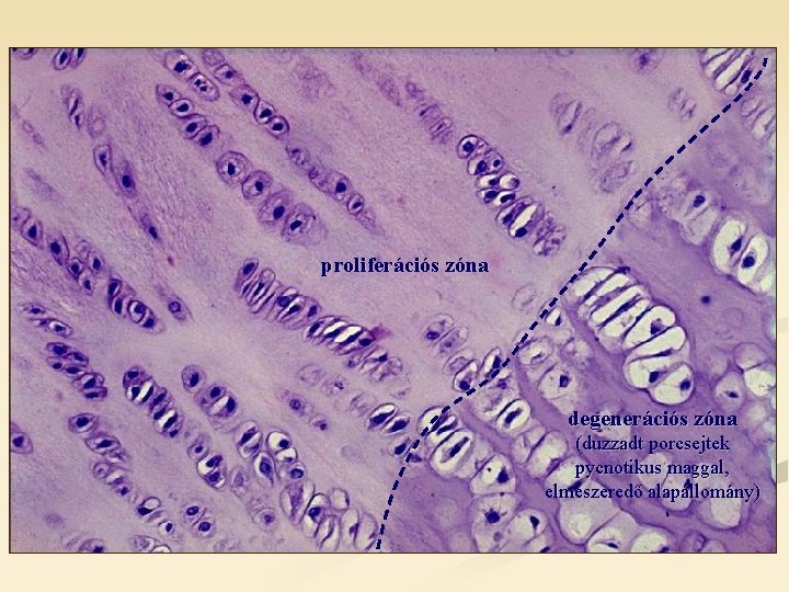 proliferációs zóna degenerációs zóna (duzzadt porcsejtek pycnotikus maggal, elmeszeredő alapállomány) 