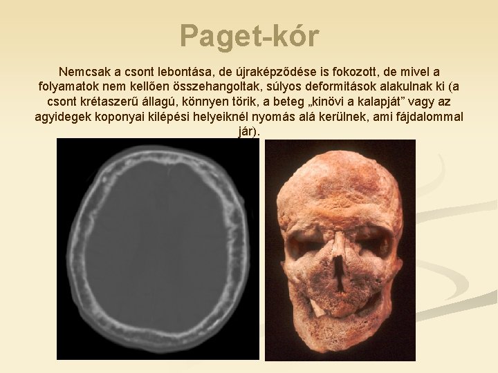 Paget-kór Nemcsak a csont lebontása, de újraképződése is fokozott, de mivel a folyamatok nem