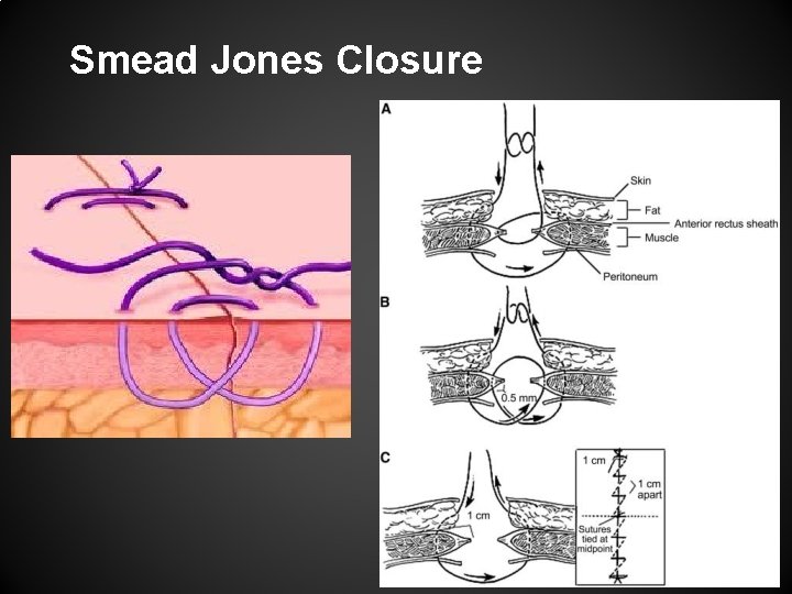 Smead Jones Closure 