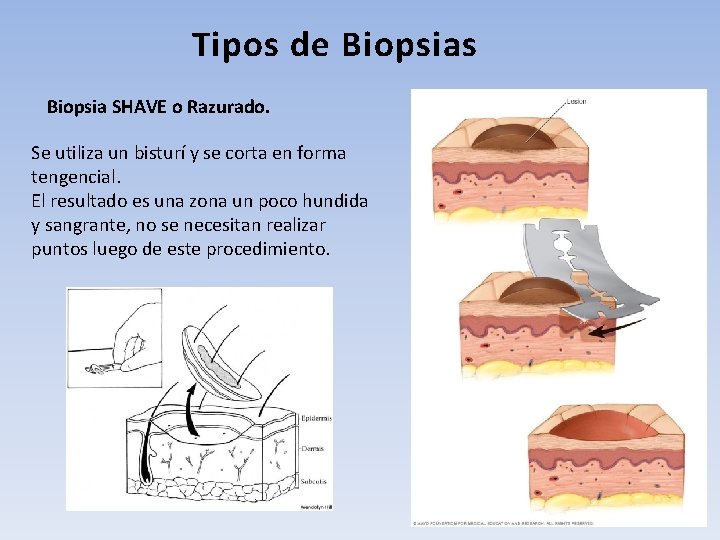 Tipos de Biopsias Biopsia SHAVE o Razurado. Se utiliza un bisturí y se corta