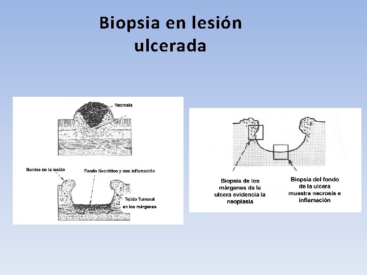 Biopsia en lesión ulcerada 