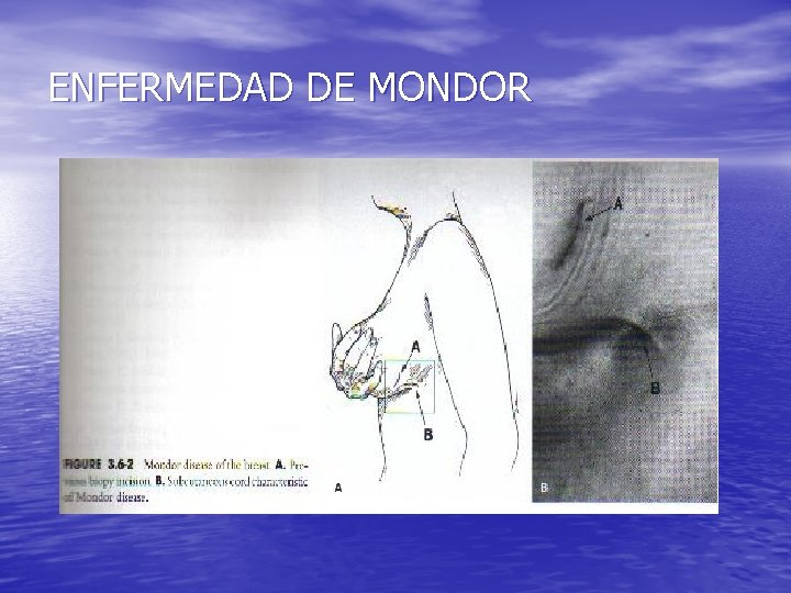 ENFERMEDAD DE MONDOR 