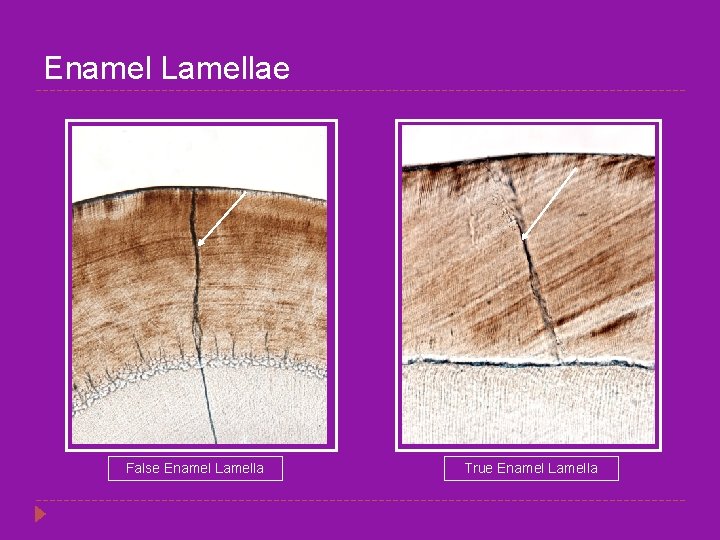 Enamel Lamellae False Enamel Lamella True Enamel Lamella 