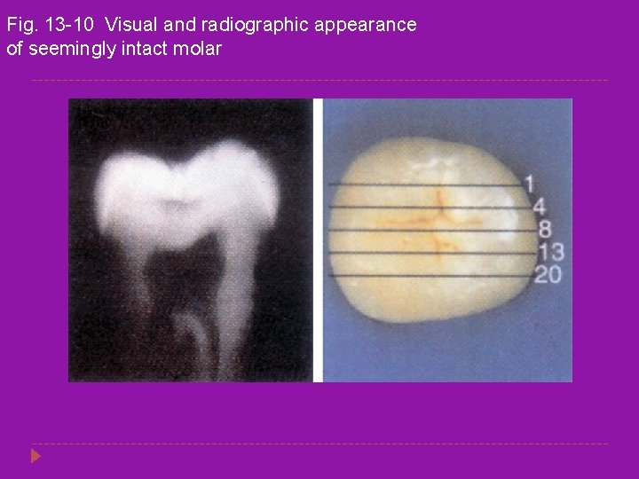 Fig. 13 -10 Visual and radiographic appearance of seemingly intact molar 