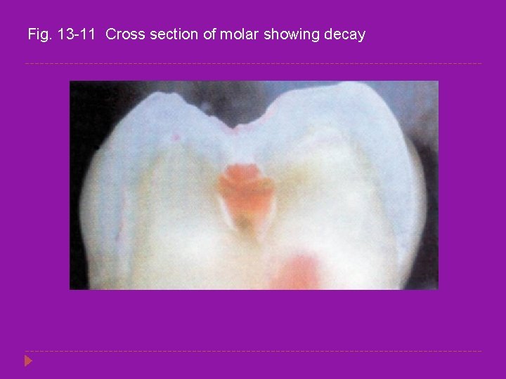 Fig. 13 -11 Cross section of molar showing decay 