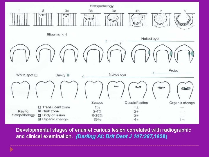 Developmental stages of enamel carious lesion correlated with radiographic and clinical examination. (Darling Al: