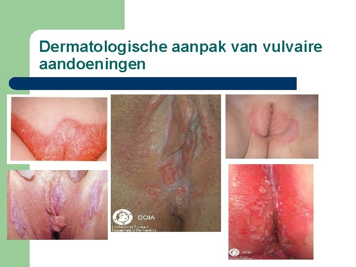 Dermatologische aanpak van vulvaire aandoeningen 