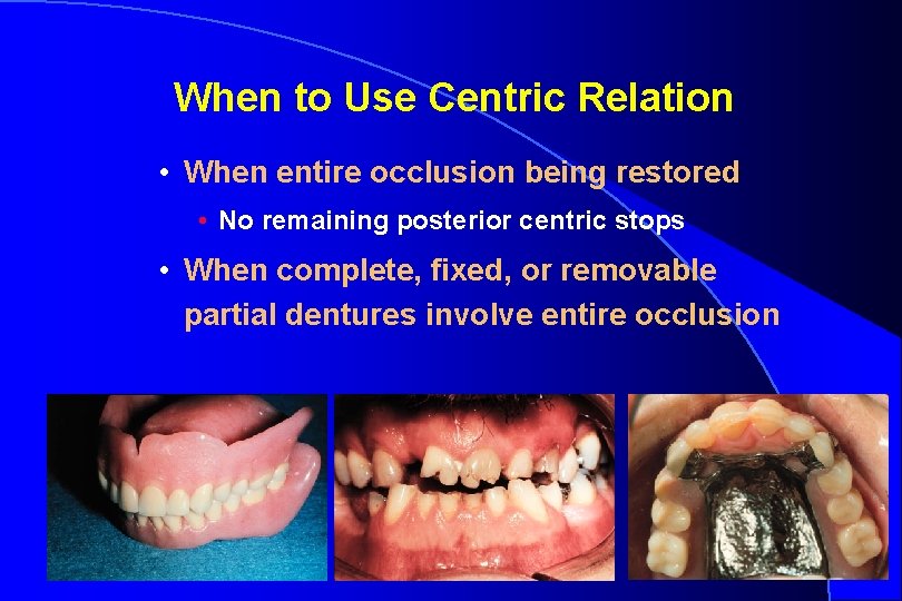 When to Use Centric Relation • When entire occlusion being restored • No remaining