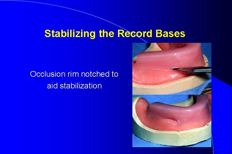 Stabilizing the Record Bases Occlusion rim notched to aid stabilization Robert W. Loney 