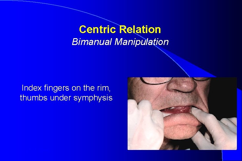 Centric Relation Bimanual Manipulation Index fingers on the rim, thumbs under symphysis Robert W.