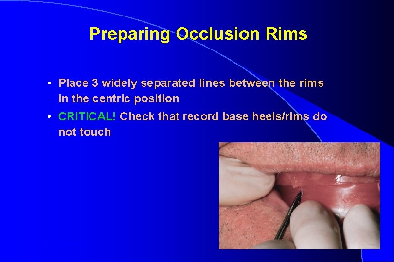 Preparing Occlusion Rims • Place 3 widely separated lines between the rims in the