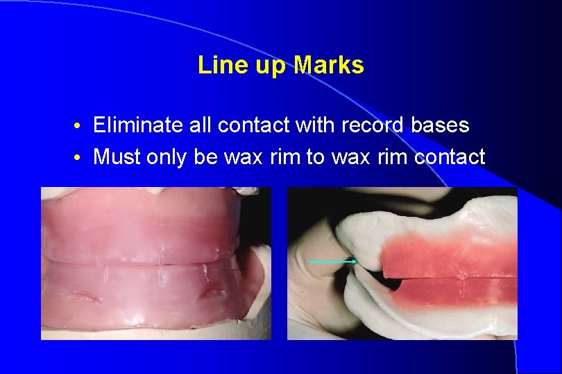 Line up Marks • Eliminate all contact with record bases • Must only be