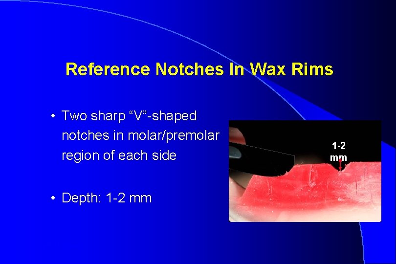 Reference Notches In Wax Rims • Two sharp “V”-shaped notches in molar/premolar region of