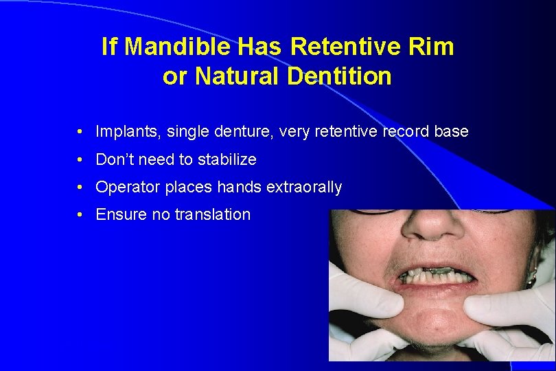 If Mandible Has Retentive Rim or Natural Dentition • Implants, single denture, very retentive