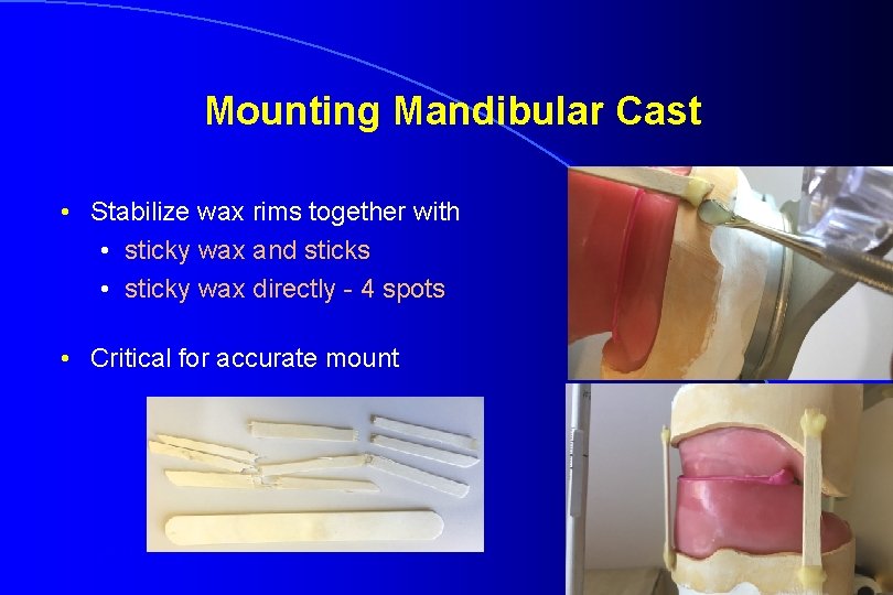Mounting Mandibular Cast • Stabilize wax rims together with • sticky wax and sticks