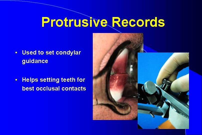 Protrusive Records • Used to set condylar guidance • Helps setting teeth for best