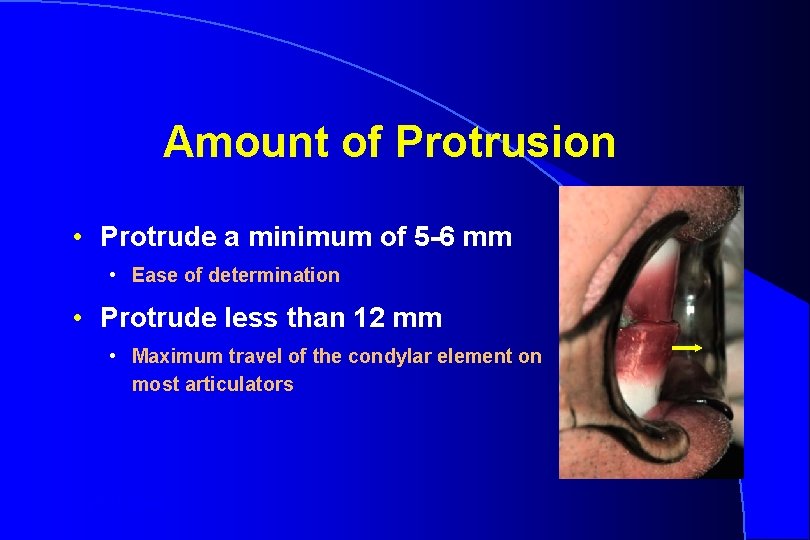 Amount of Protrusion • Protrude a minimum of 5 -6 mm • Ease of