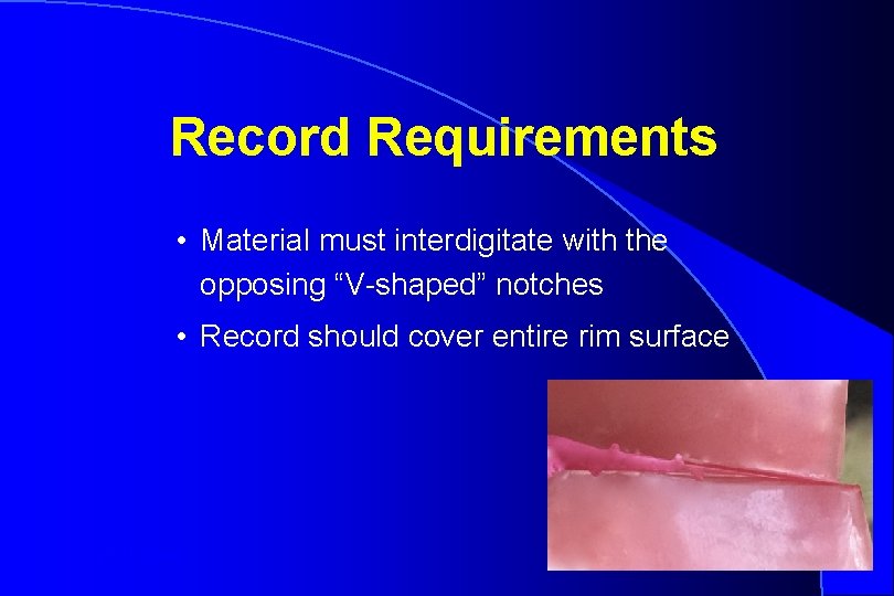 Record Requirements • Material must interdigitate with the opposing “V-shaped” notches • Record should