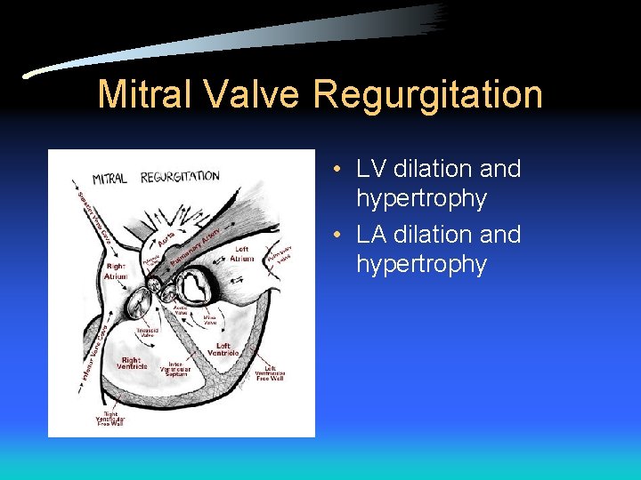 Mitral Valve Regurgitation • LV dilation and hypertrophy • LA dilation and hypertrophy 