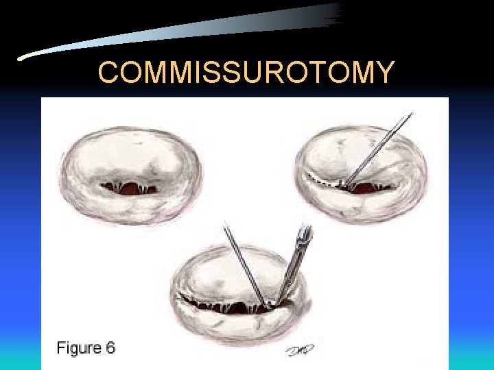 COMMISSUROTOMY 