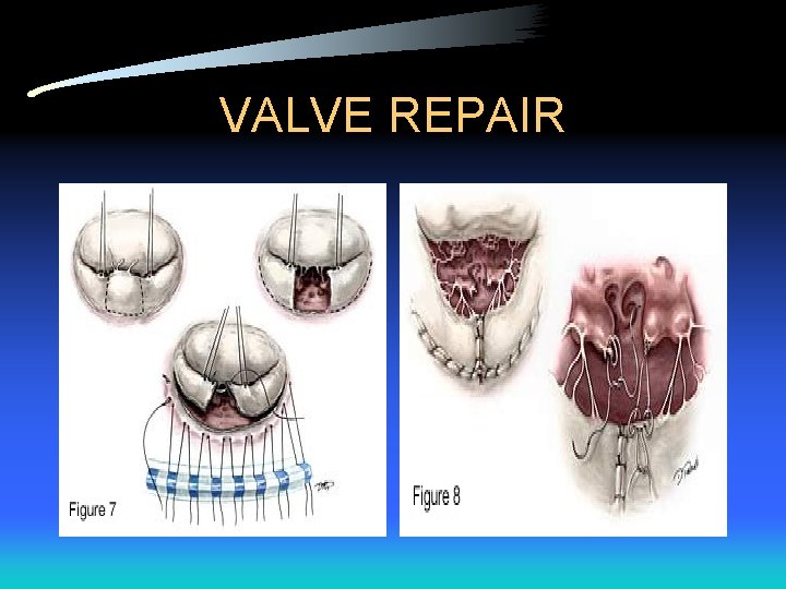 VALVE REPAIR 