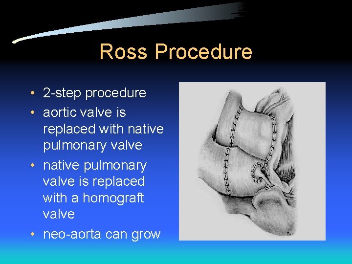 Ross Procedure • 2 -step procedure • aortic valve is replaced with native pulmonary