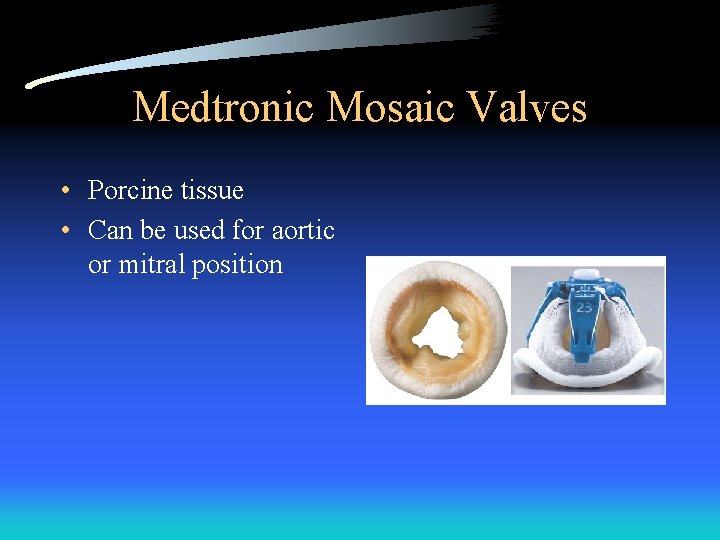 Medtronic Mosaic Valves • Porcine tissue • Can be used for aortic or mitral