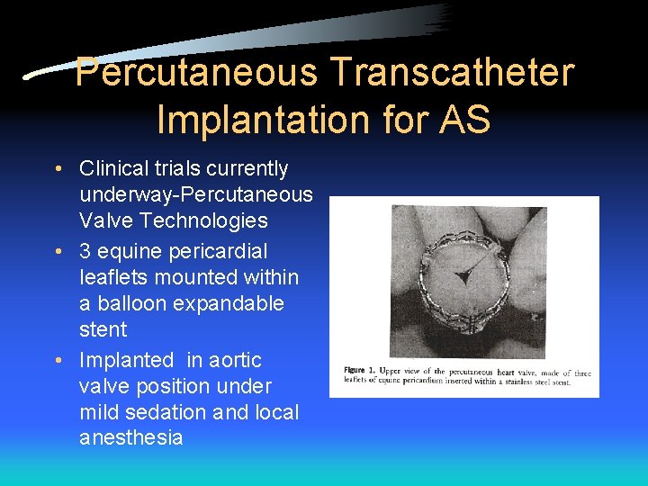 Percutaneous Transcatheter Implantation for AS • Clinical trials currently underway-Percutaneous Valve Technologies • 3