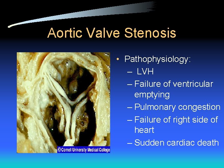 Aortic Valve Stenosis • Pathophysiology: – LVH – Failure of ventricular emptying – Pulmonary