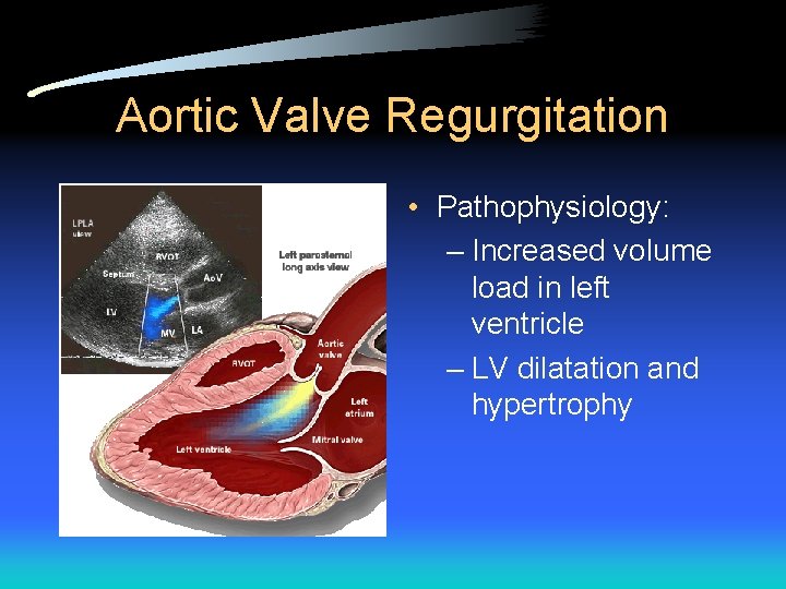 Aortic Valve Regurgitation • Pathophysiology: – Increased volume load in left ventricle – LV