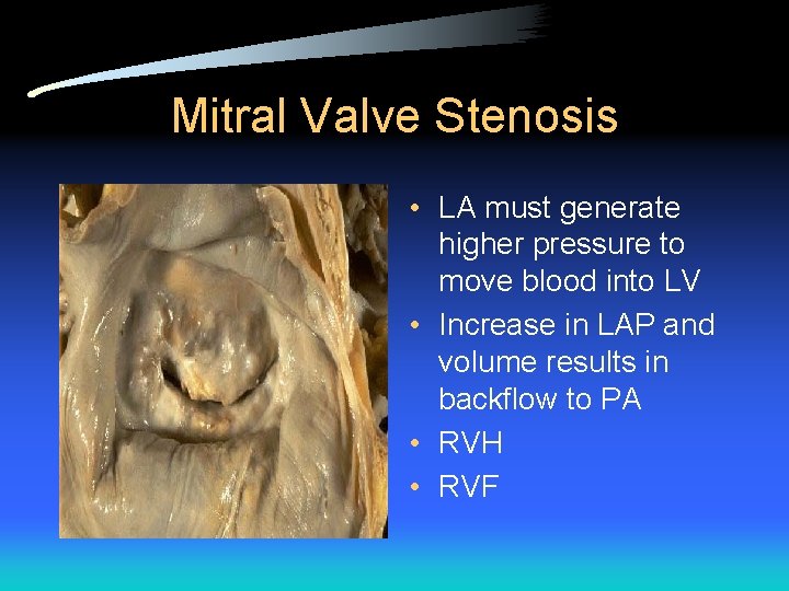 Mitral Valve Stenosis • LA must generate higher pressure to move blood into LV