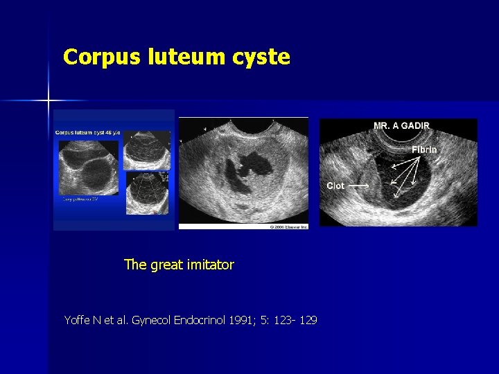 Corpus luteum cyste The great imitator Yoffe N et al. Gynecol Endocrinol 1991; 5: