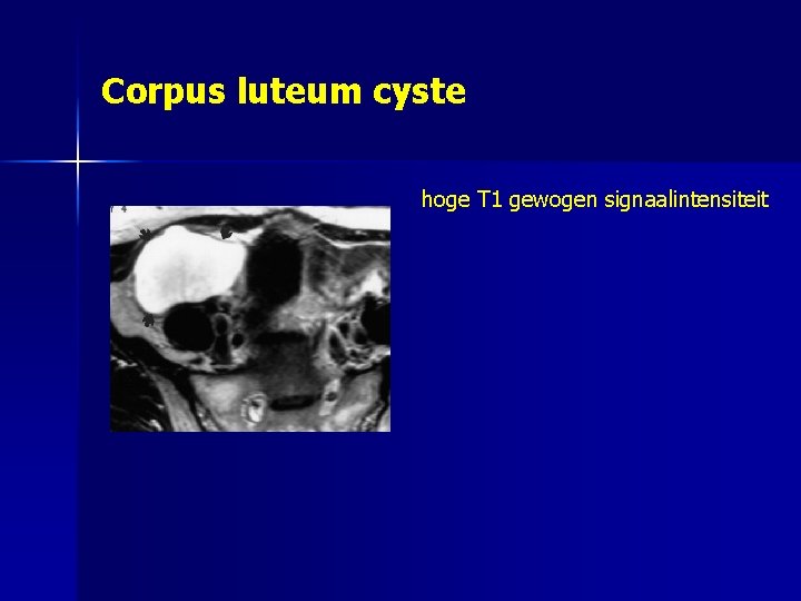 Corpus luteum cyste hoge T 1 gewogen signaalintensiteit 