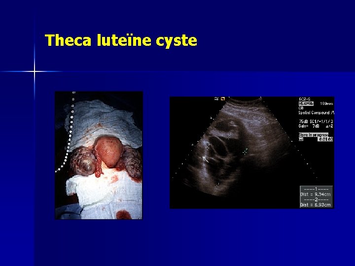 Theca luteïne cyste 