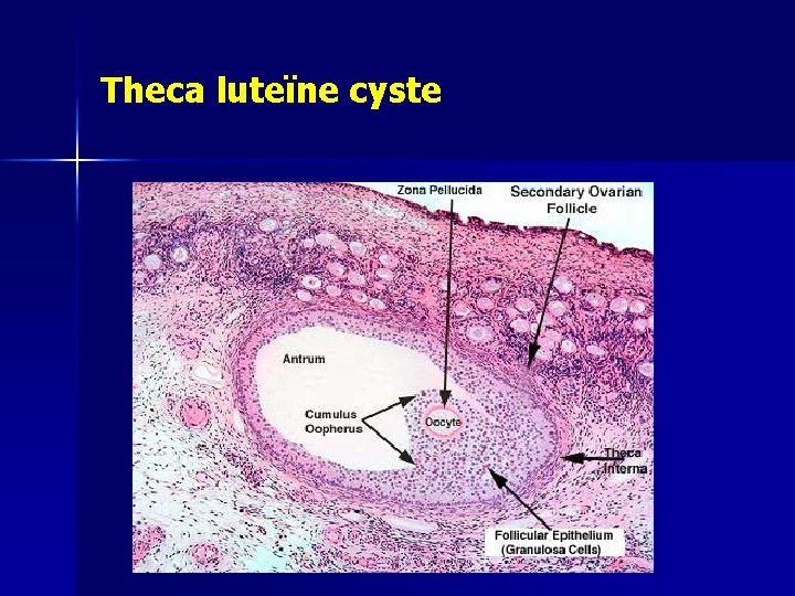 Theca luteïne cyste 