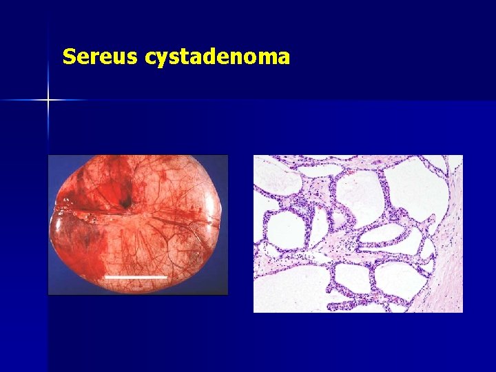 Sereus cystadenoma 