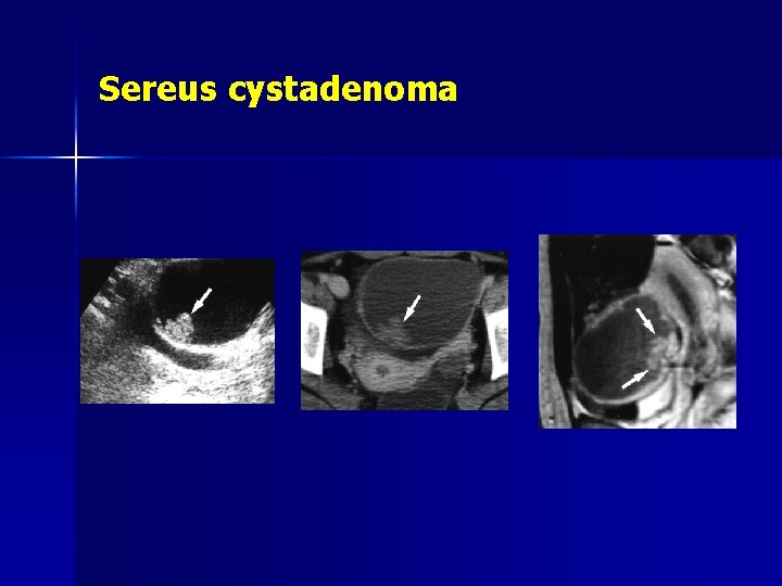 Sereus cystadenoma 