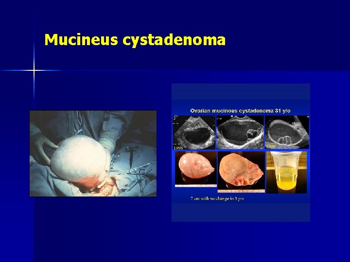 Mucineus cystadenoma 