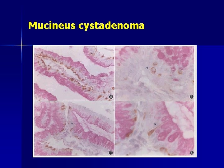 Mucineus cystadenoma 