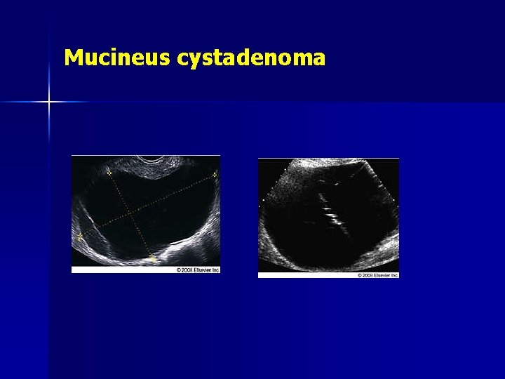 Mucineus cystadenoma 